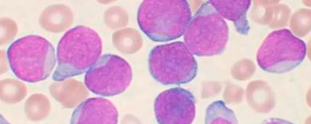 “Lápiz” genético logra la remisión de leucemia letal en dos adolescentes desahuciados