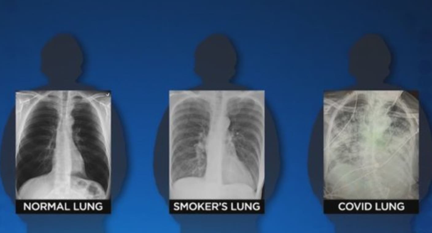 Легкие здорового человека и курильщика на рентгене