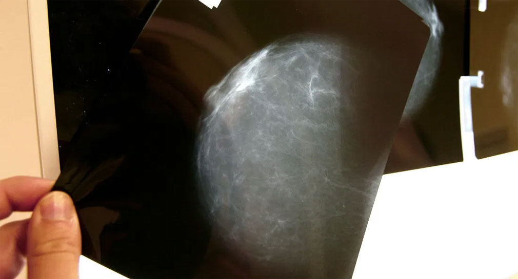 Macro estudio sugiere que nunca exista cura universal contra el cáncer