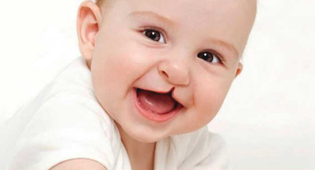 Lanza Rostros Felices convocatoria de cirugía para corregir labio o paladar hendido en niños de 0 a 24 meses en Hermosillo