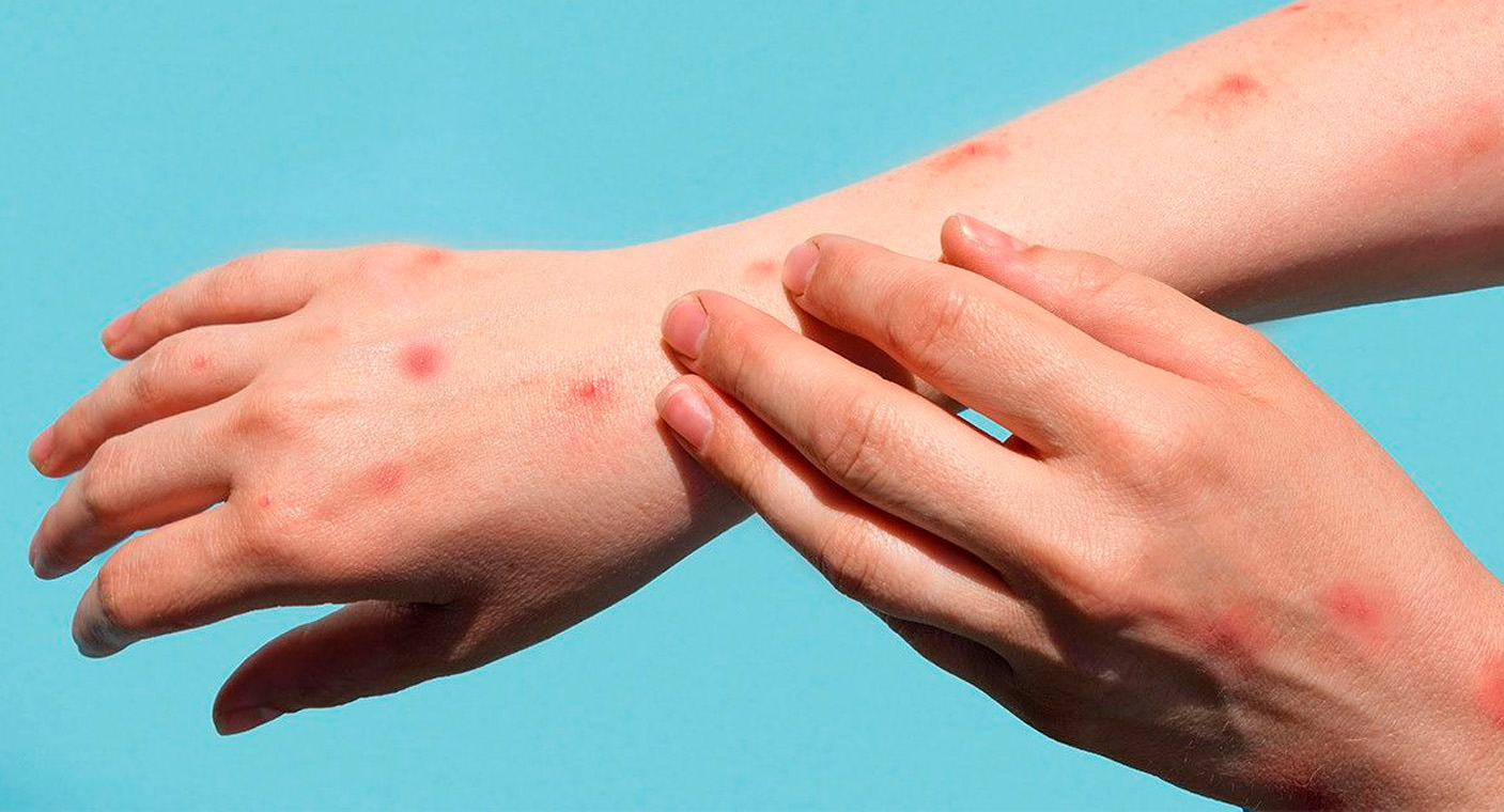 Casos de viruela símica se han reducido 90% a nivel mundial, reporta la OMS