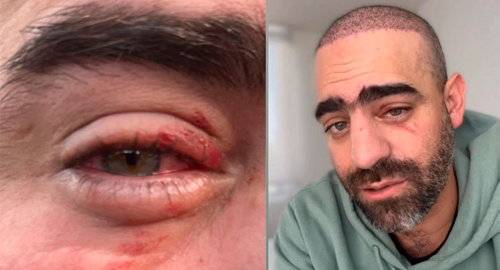 “Veo un borroso”: Arturo Islas se lastima ojo tras un accidente (VIDEO)