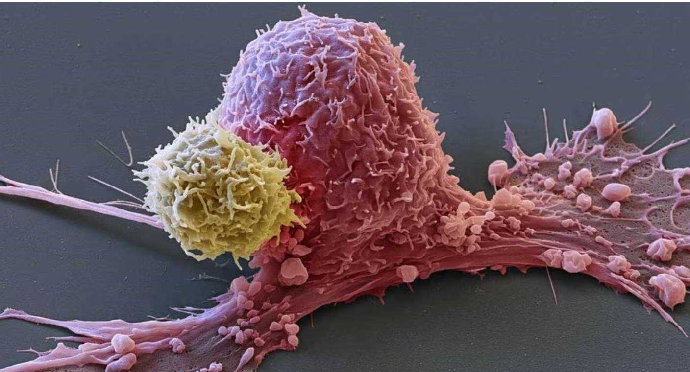 Vacuna de ARN logra primer éxito contra el cáncer de páncreas, el tumor más letal