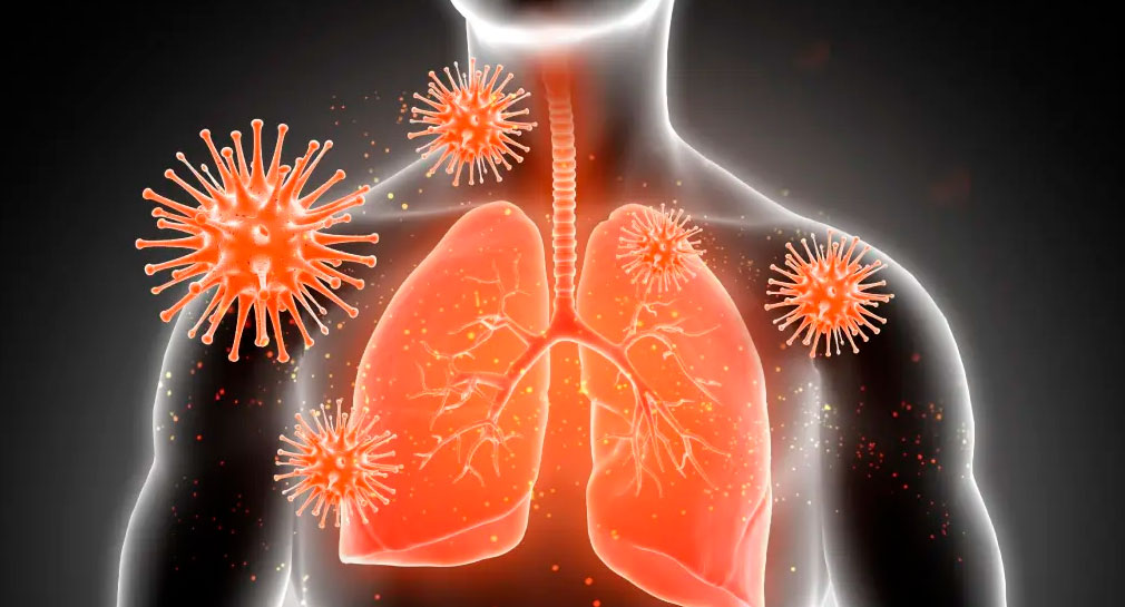 Podrían morir un millón de personas de tuberculosis para 2025 si no se toman medidas: ONU