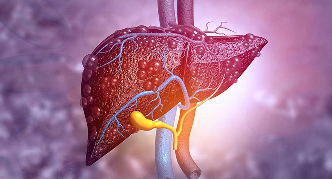 Hepatitis podría matar más personas que la malaria, tuberculosis y VIH juntas
