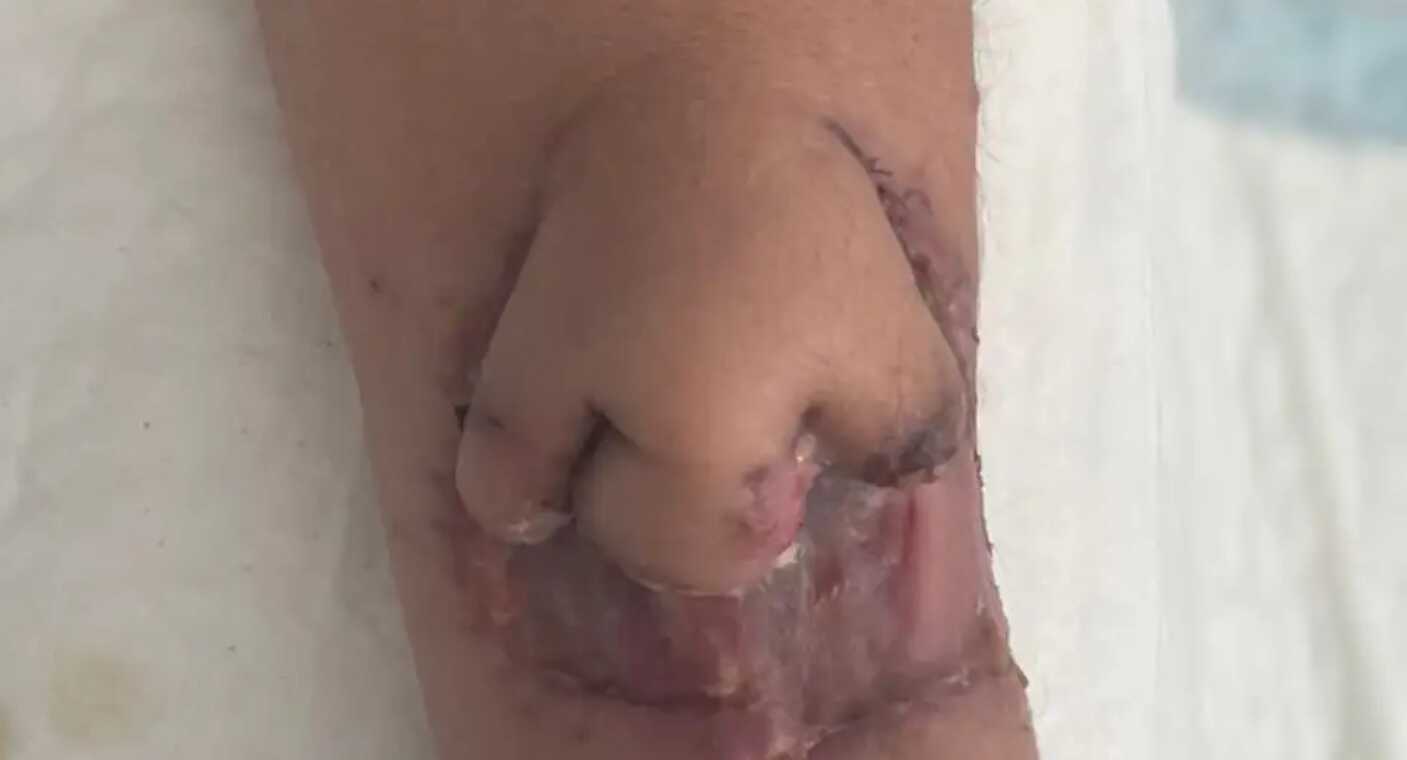Cirujanos imprimen nariz en 3D y la conectan al brazo de paciente