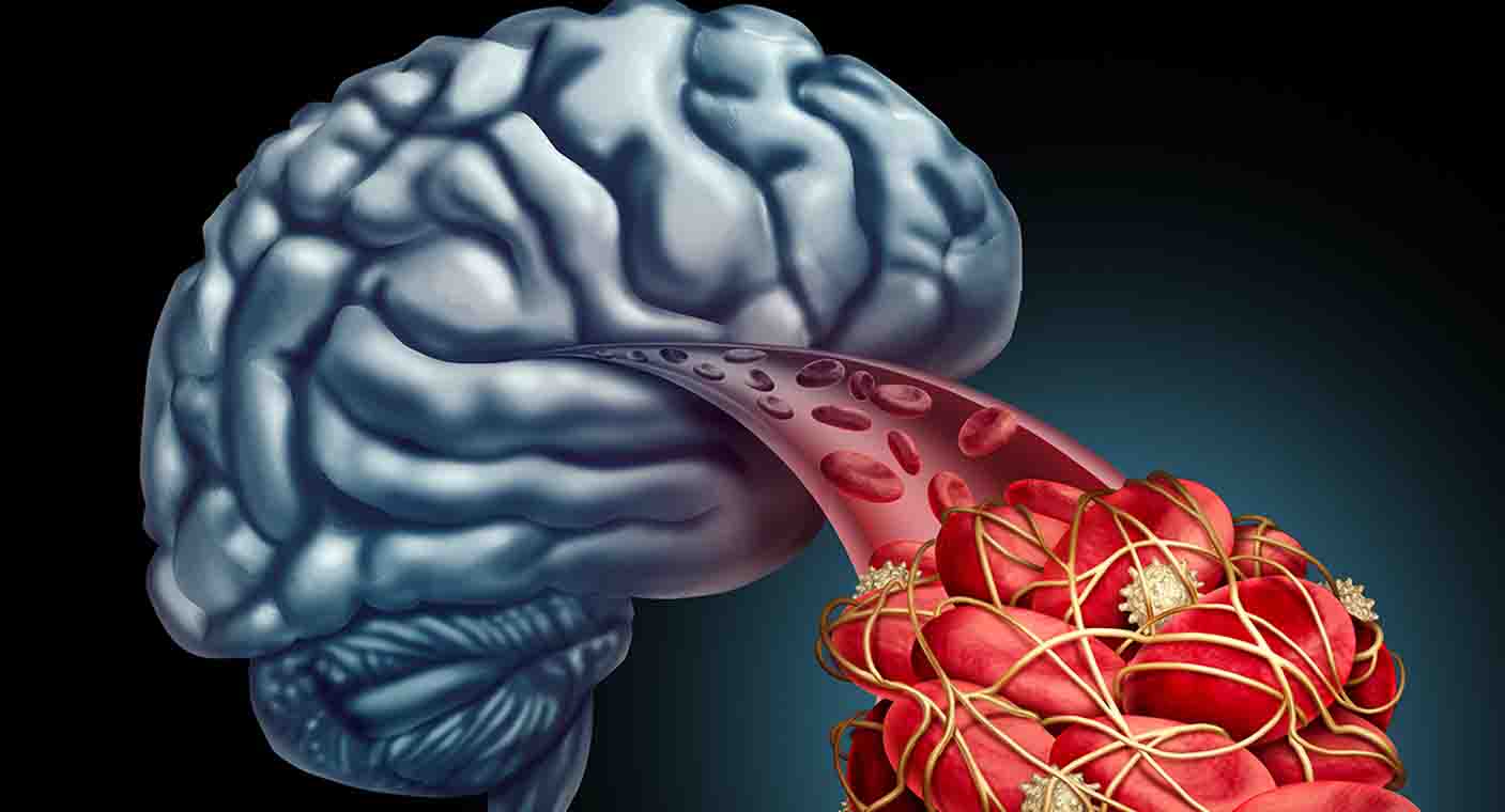 Infarto cerebral: la segunda causa de discapacidad en México; cada año se presentan 170 mil casos