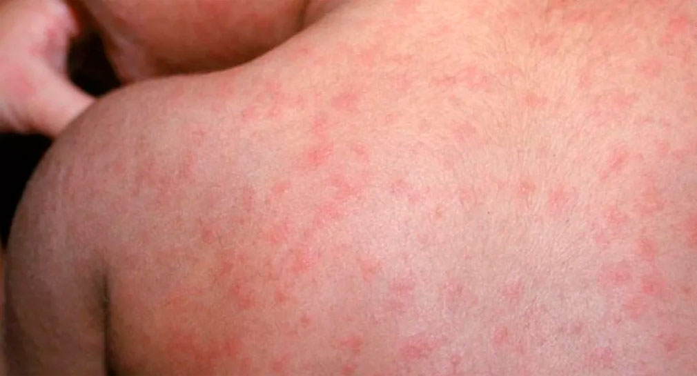 Secretaría de Salud emite aviso epidemiológico por sarampión