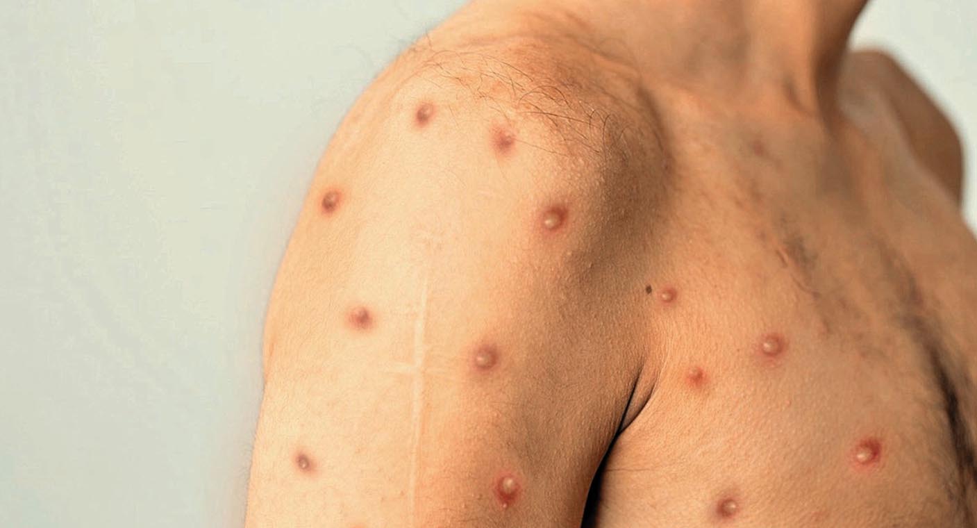 Continúa Sonora con 2 casos importados de mpox, confirma Salud