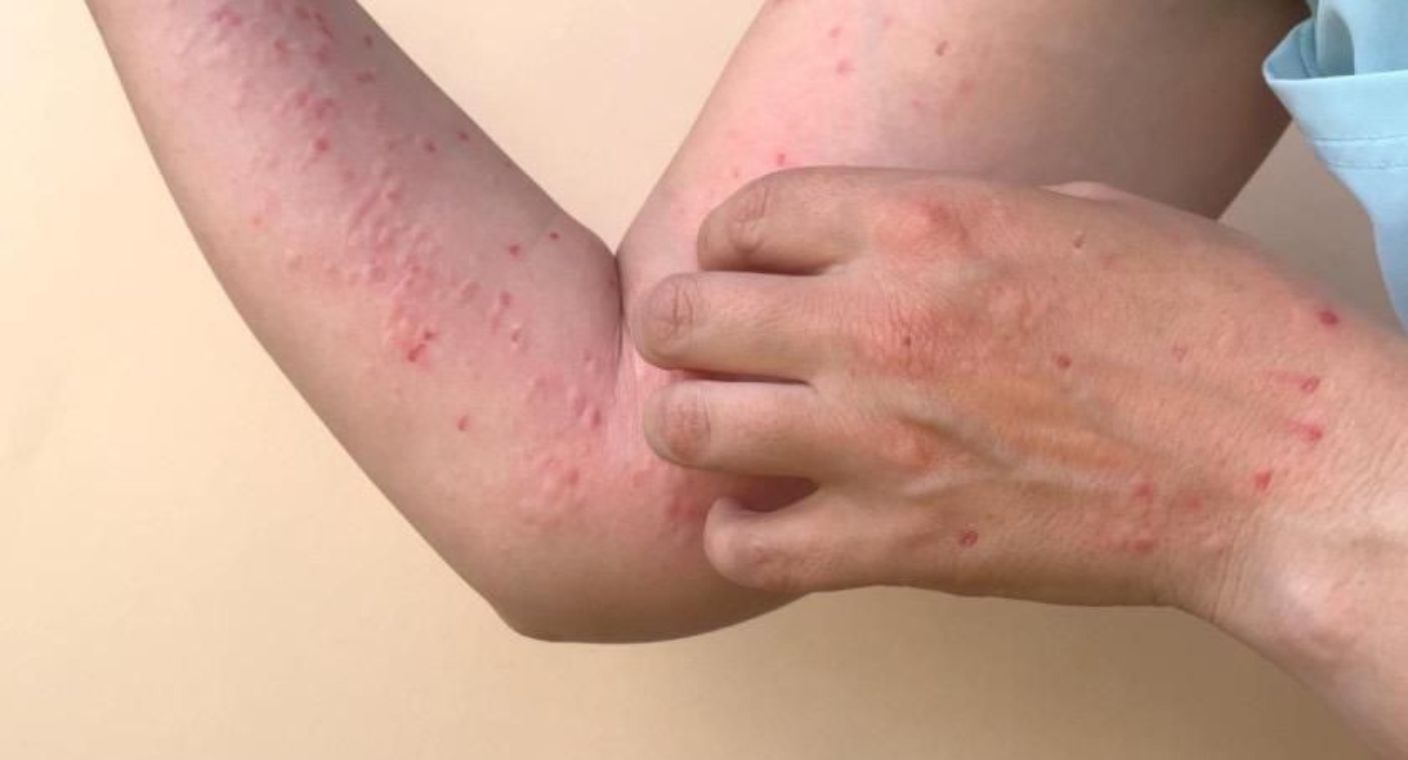 Descartan casos positivos de viruela del mono en Sonora; Salud refuerza vigilancia