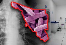 Sonora acumula mil 89 casos de tuberculosis en 2025: enfermedad puede afectar a cualquiera, tratamiento debe seguirse 6 meses, afirma especialista