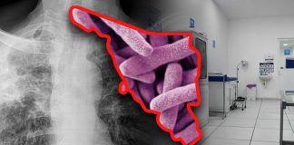 Sonora acumula mil 89 casos de tuberculosis en 2025: enfermedad puede afectar a cualquiera, tratamiento debe seguirse 6 meses, afirma especialista