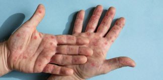 Nueva cepa de mpox detectada en Inglaterra: esto es lo que se sabe