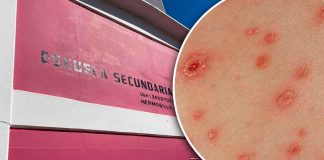 Casos de varicela en secundaria de Hermosillo son aislados, no hay riesgo para la población: SEC Sonora