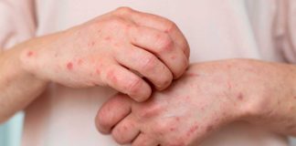 Confirman primera muerte por sarampión en México en 2026