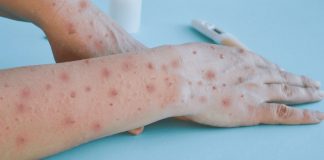 Detectan primer caso de viruela símica en México en paciente de origen alemán