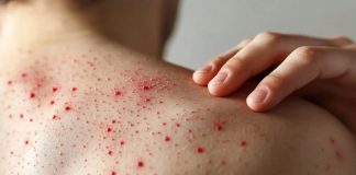 Cubrebocas obligatorio en escuelas de Jalisco por brote de sarampión: inicia medida sanitaria