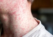 ¿Debe preocuparse Sonora por el sarampión? ISSSTE advierte sobre efectos graves en la salud