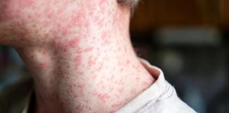 ¿Debe preocuparse Sonora por el sarampión? ISSSTE advierte sobre efectos graves en la salud