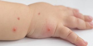 CDMX confirma muerte de bebé de 14 meses por sarampión ocurrida en diciembre de 2025