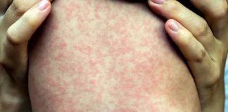 OPS emite alerta por sarampión en América ante repunte histórico de casos; México encabeza listado