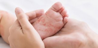 México supera los 10 mil casos confirmados de sarampión: Secretaría de Salud